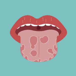 Oral cancer tumor