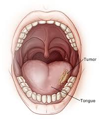 Oral Cancer Tumors