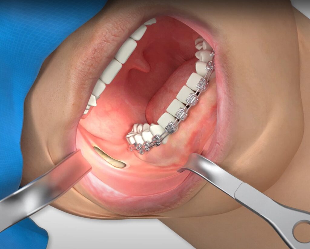 TMJ -Arthroscopic Minimally invasive Surgery