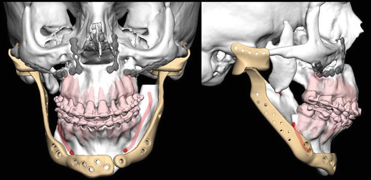 TMJ -Arthroscopic Minimally invasive Surgery