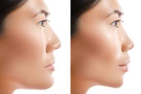 Jaw Line Surgery