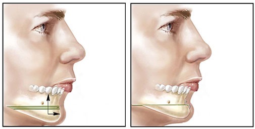 Chin Surgery - Genioplasty