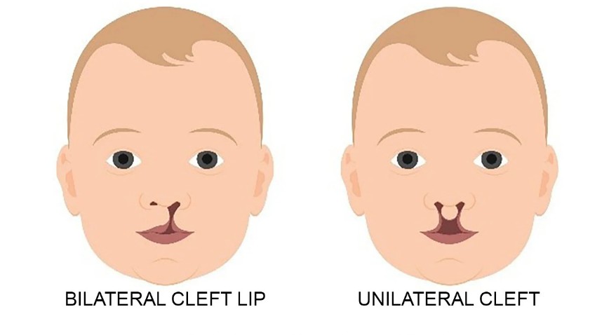 Cleft & Craniofacial Surgery.