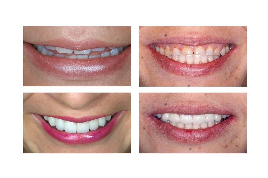 Full mouth Rehabilitation using Dental