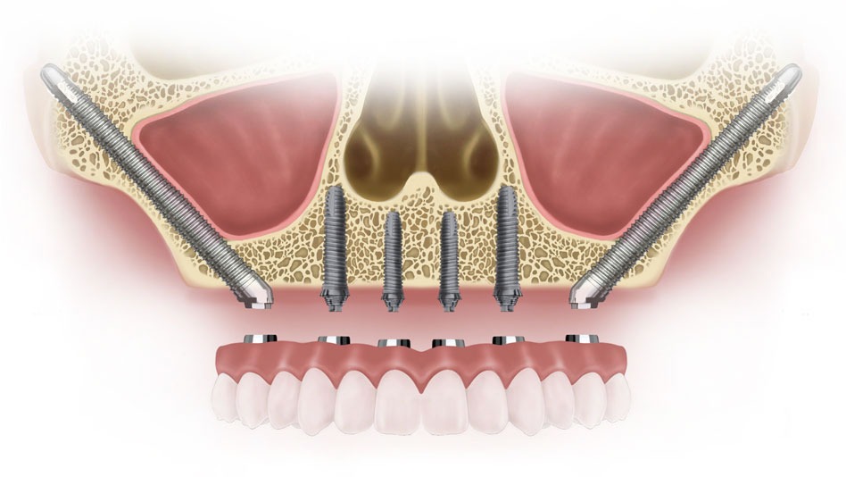 Craniofacial & Zygomatic Implants